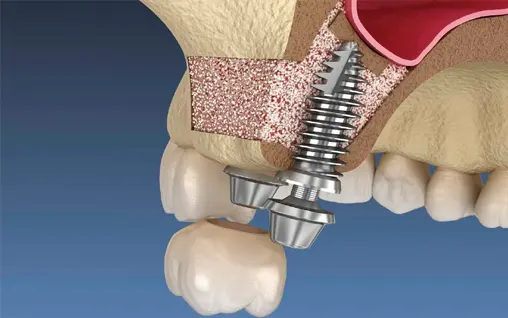 Retoque y fotomontaje didáctico: fondo limpio, foco en la pieza clave y callouts numerados